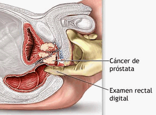 Câncer de próstata